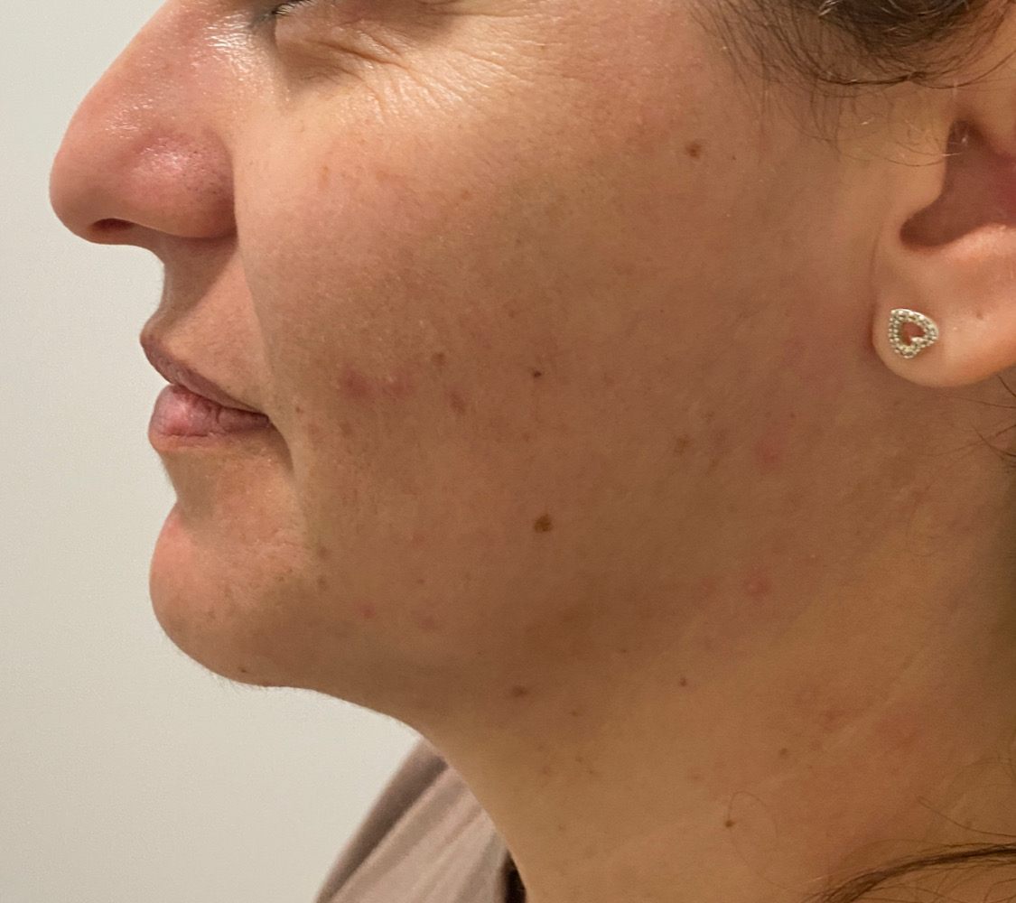 Client's cheek and jawline in profile before RF skin tightening