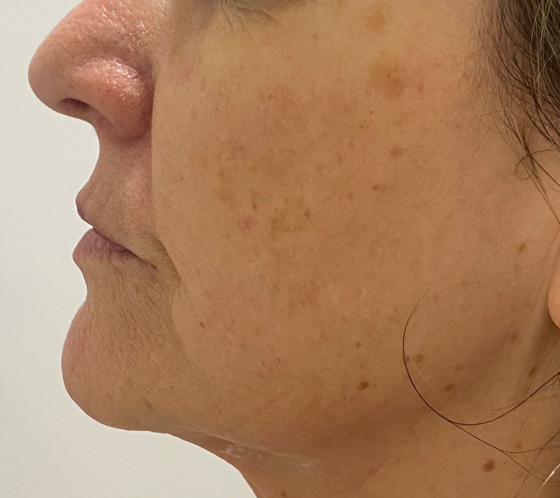 Client's lower face and jawline after a single RF skin tightening session
