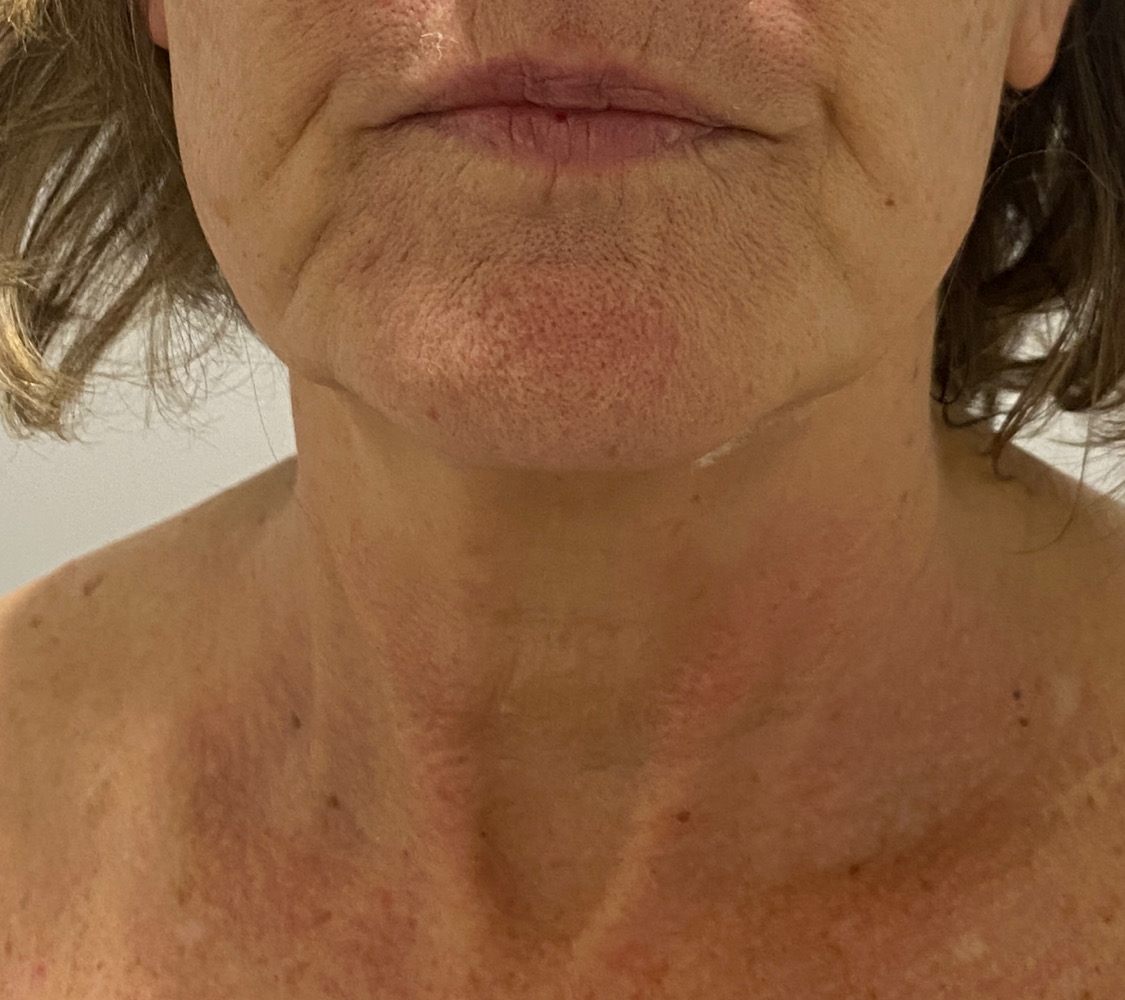 Client's jaw and neck after a single RF skin tightening session, skin looking firmer