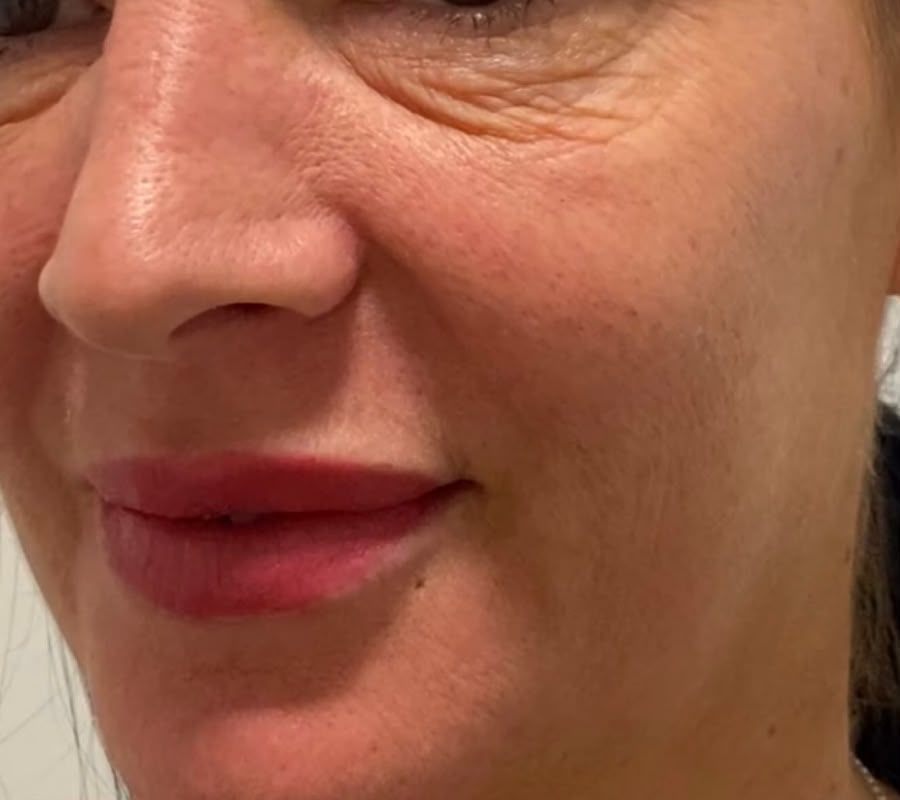 Client's cheek and smile lines before RF skin tightening