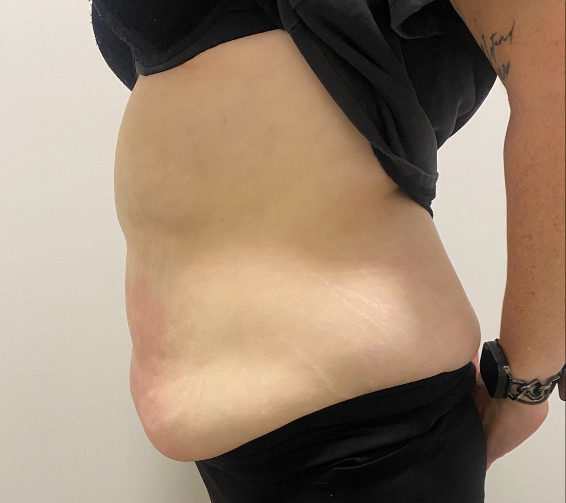 Client's abdomen after a single body contouring session, visibly firmer