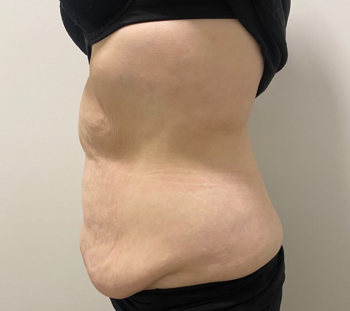 Client's abdomen before body contouring