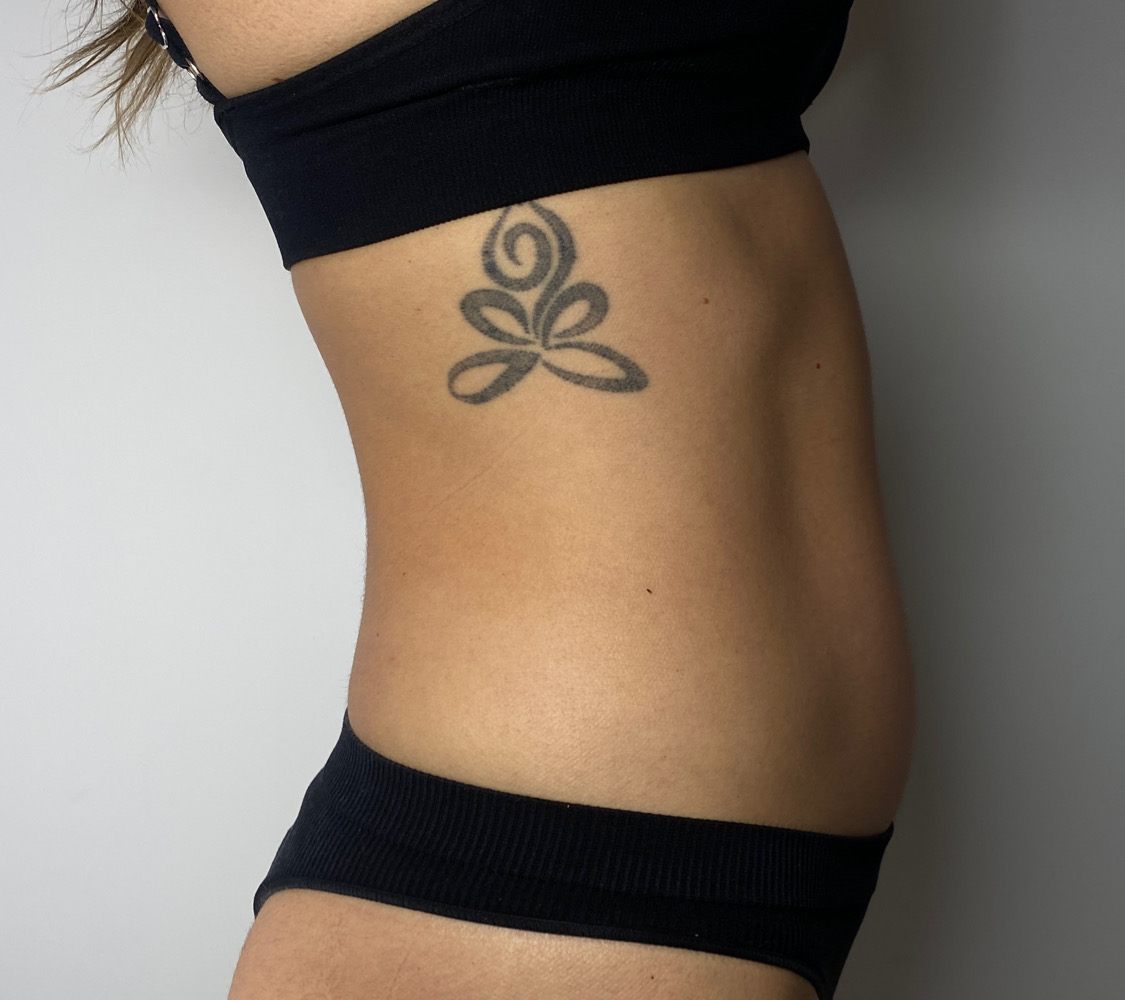 Client's waist and tummy in side profile after one body contouring session, firmer and more defined