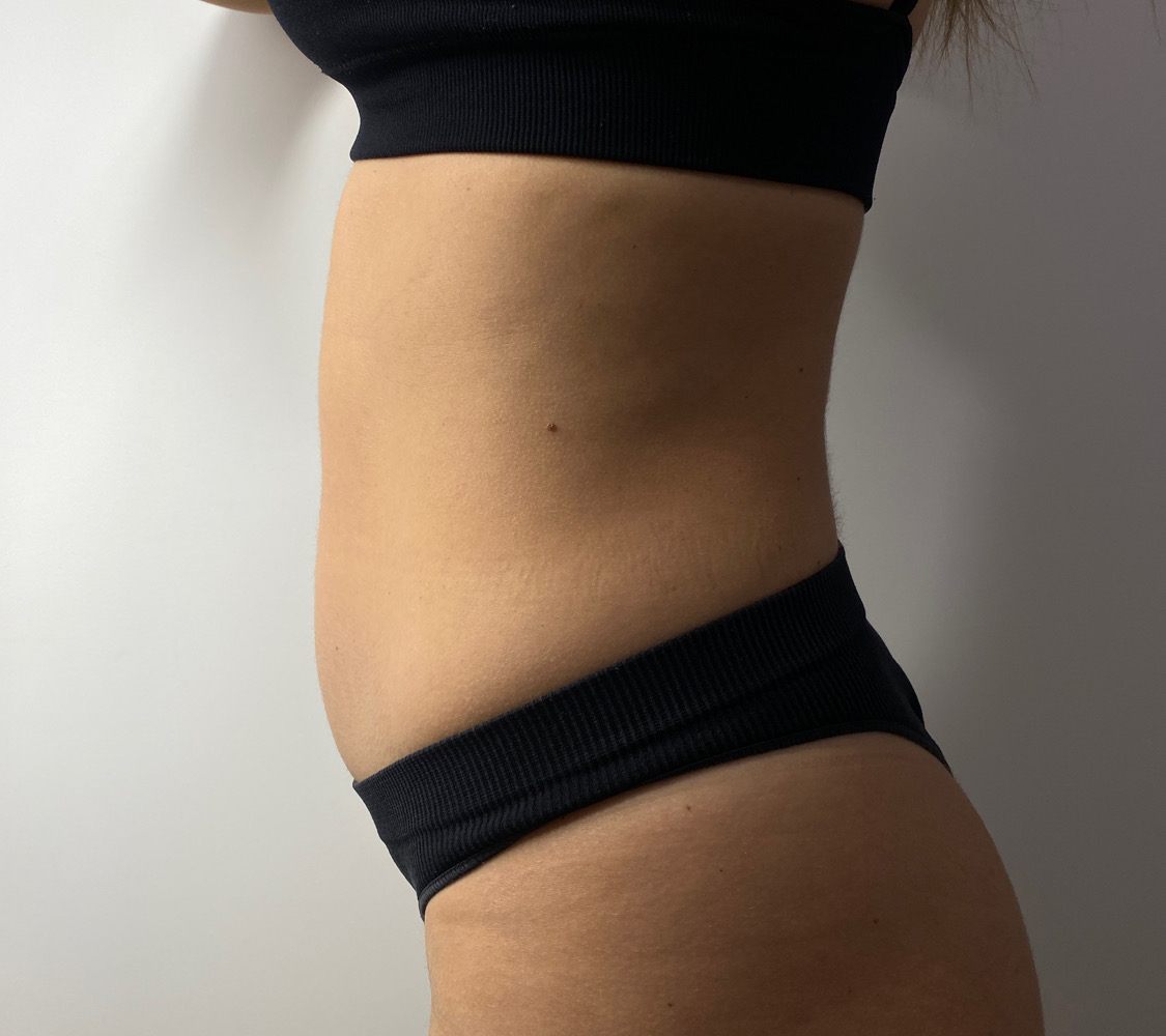 Client's waist and tummy in side profile before body contouring